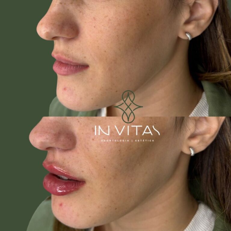 Correção de Assimetria Labial